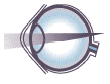 Hyperopia