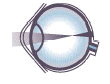 Myopia