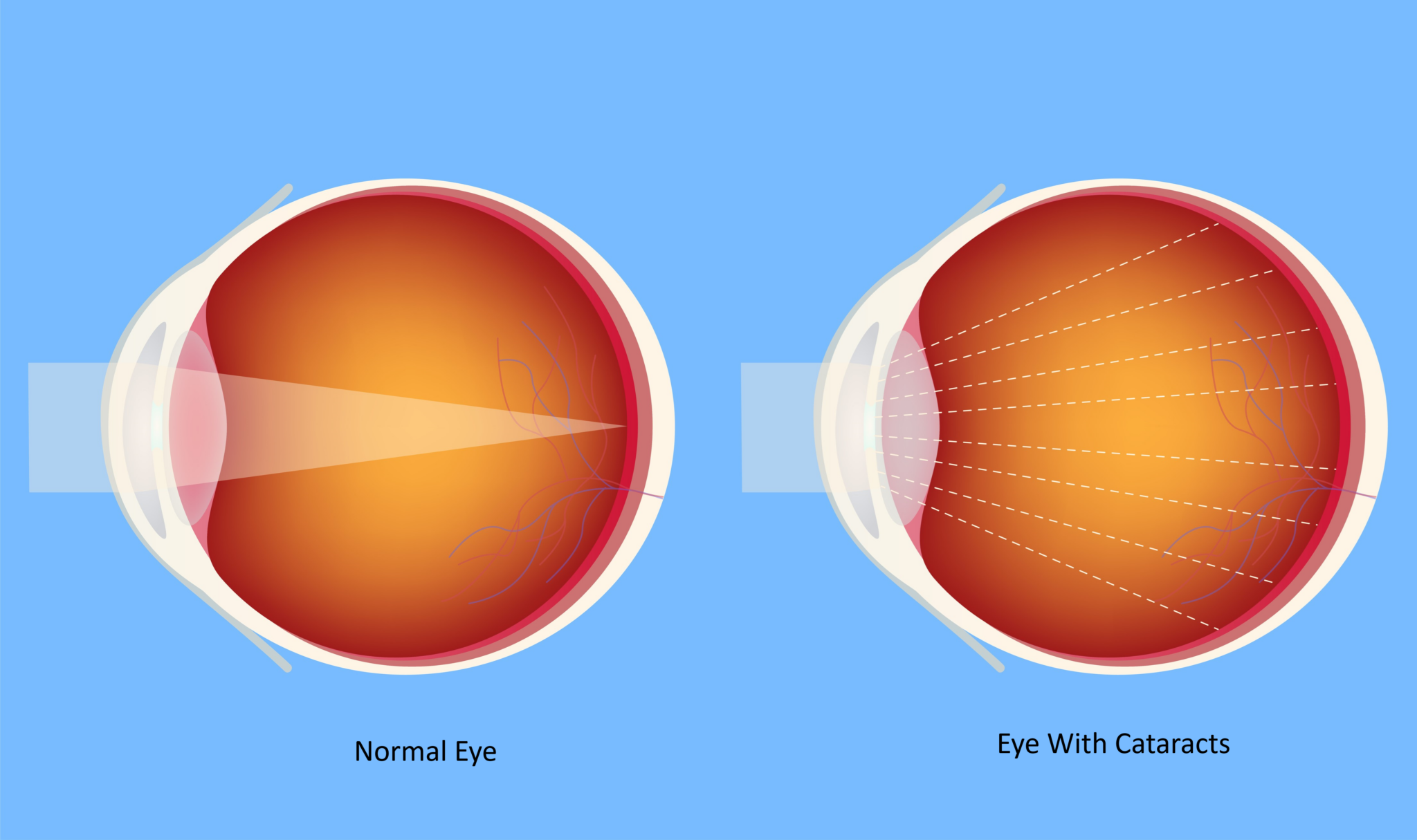 Can You Have LASIK After Cataract Surgery? The LASIK Vision Institute